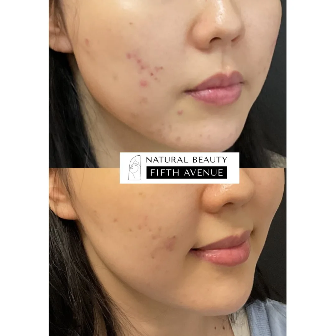 Before and after acne scar treatment showing reduced scarring on cheek and jawline